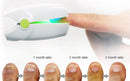 Portable Fungus Nail Laser